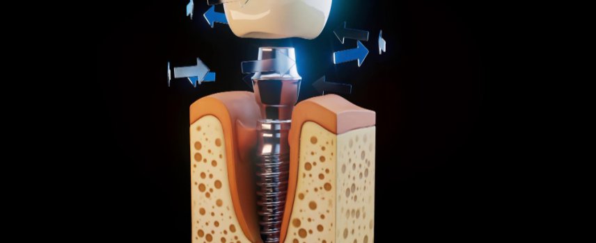 İmplant Diş Tedavisinde Başarıyı Belirleyen Faktörler