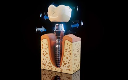 İmplant Diş Tedavisinde Başarıyı Belirleyen Faktörler