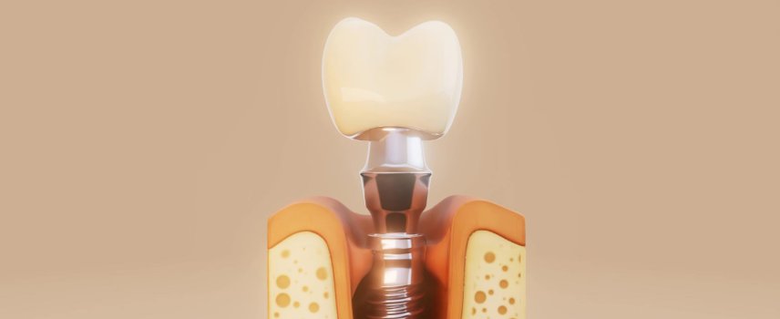 Dental İmplant Tedavisi Nedir?