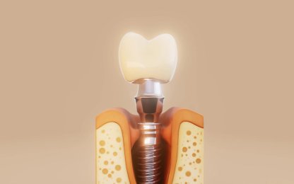 Dental İmplant Tedavisi Nedir?