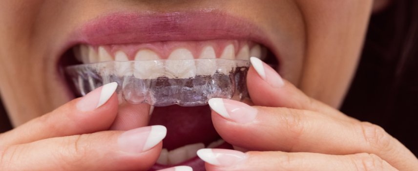 Invisalign Tedavisinde Süreç ve Elde Edilen Sonuçlar