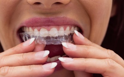 Invisalign Tedavisinde Süreç ve Elde Edilen Sonuçlar